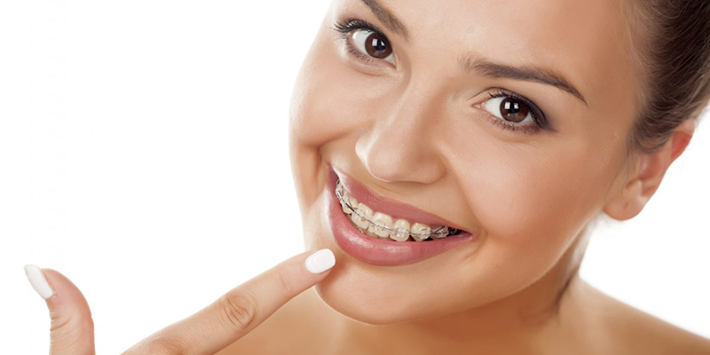 Ortodonzia fissa 'tradizionale'