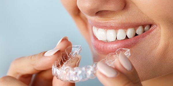 Ortodonzia fissa Invisalign